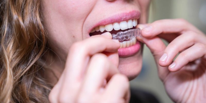 Invisalign Treatment Guide