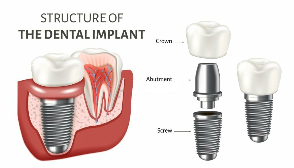 dental implant structure