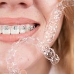 Invisalign Dentists vs. Traditional Orthodontists: What You Need to Know_FI