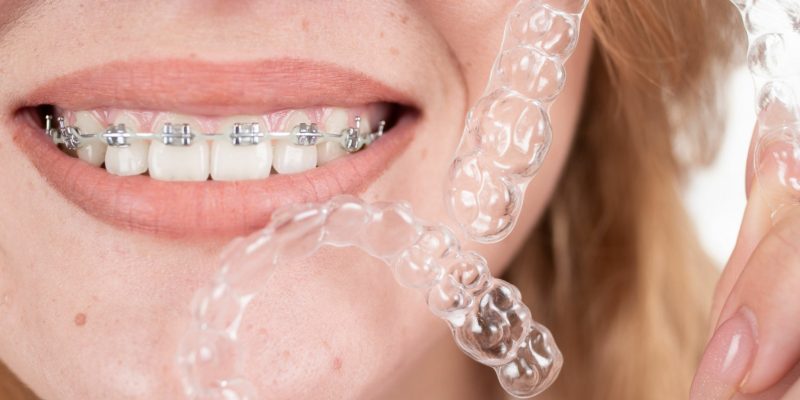 Invisalign Dentists vs. Traditional Orthodontists: What You Need to Know_FI