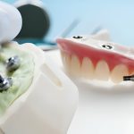 Your Complete Guide to Smile Restorations with Dentures in Columbia, SC_FI