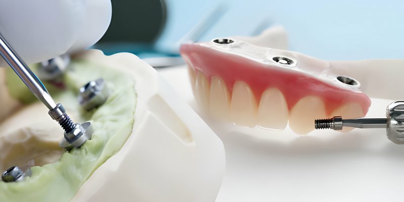 Your Complete Guide to Smile Restorations with Dentures in Columbia, SC_FI