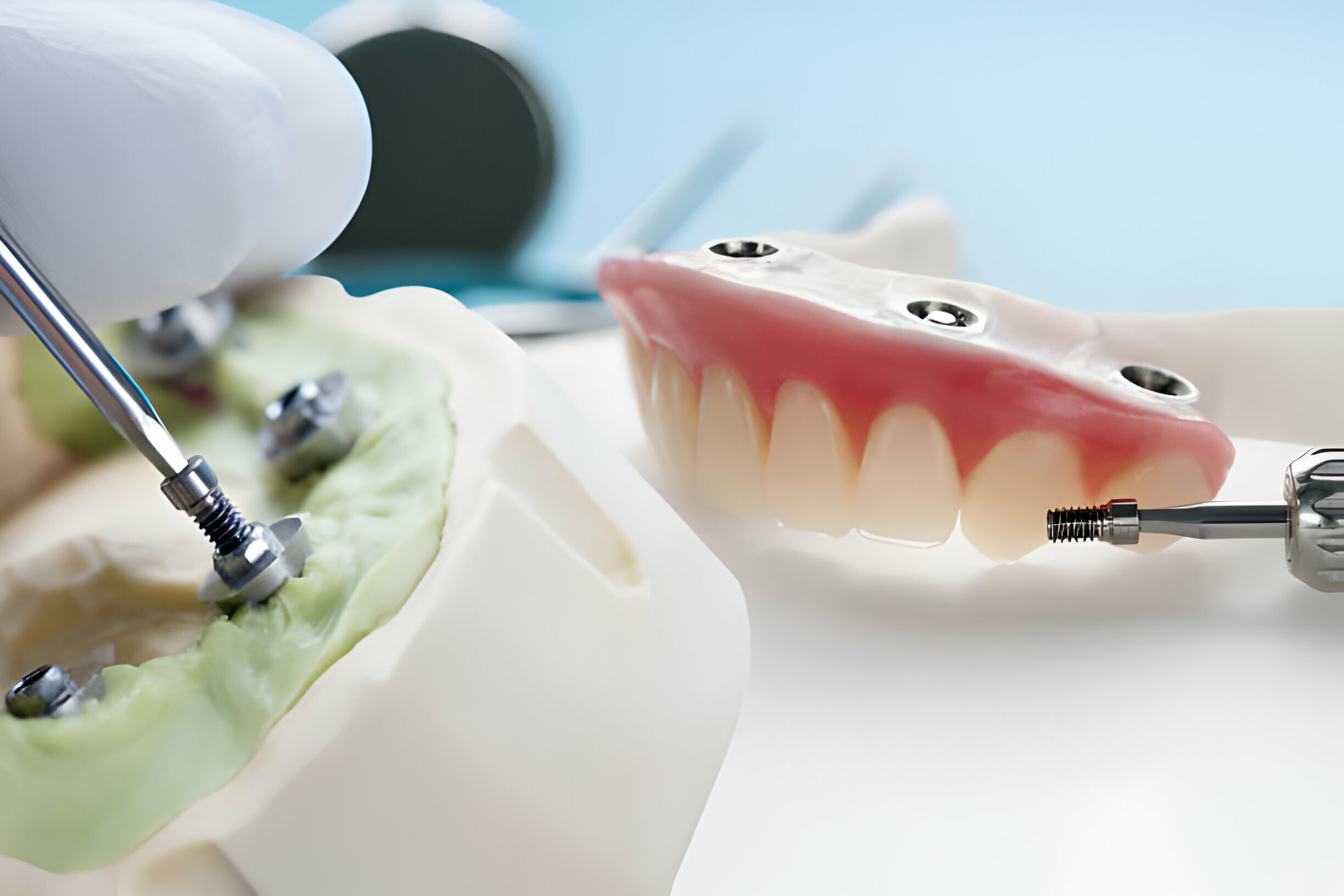 How Long Does It Take to Get Dentures  : Your Complete Guide