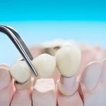 Everything You Need to Know About Dental Crowns vs. Dental Caps_FI