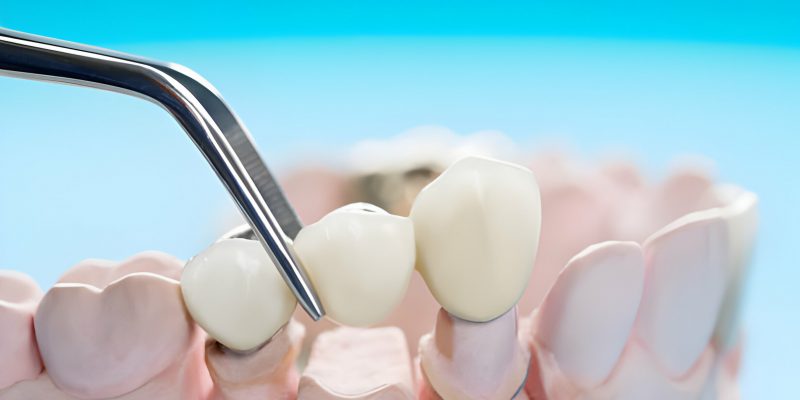 Everything You Need to Know About Dental Crowns vs. Dental Caps_FI