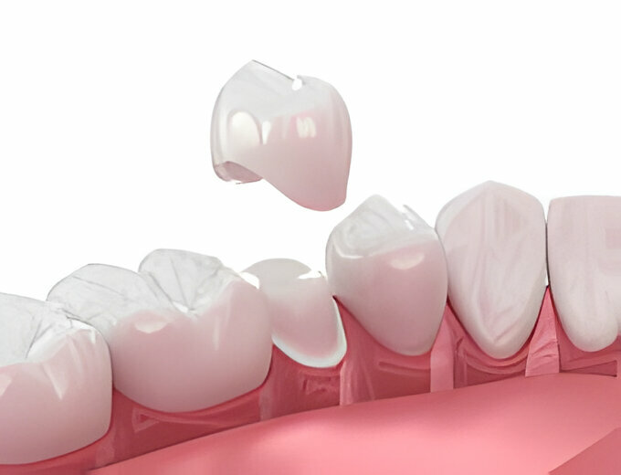 What to Expect When Getting A Dental Crown?_1
