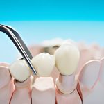 What to Expect When Getting A Dental Crown?_FI