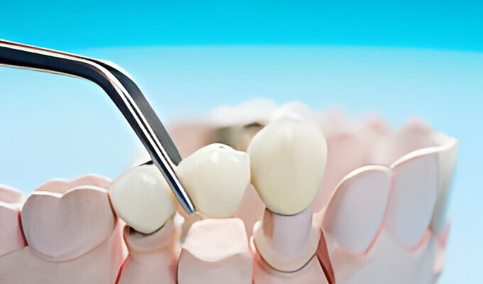 What to Expect When Getting A Dental Crown?_FI