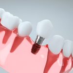 Maintaining Your Dental Implants: Top Care Tips for Long-Lasting Results in Columbia, SC