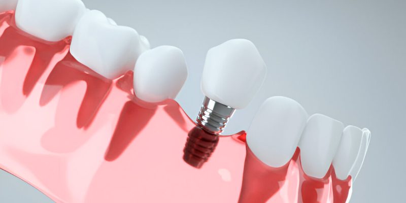 Maintaining Your Dental Implants: Top Care Tips for Long-Lasting Results in Columbia, SC