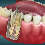 Top Benefits of Getting Your Root Canal at Carolina Smiles Family Dentistry in Columbia, SC_FI