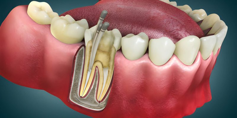Top Benefits of Getting Your Root Canal at Carolina Smiles Family Dentistry in Columbia, SC_FI